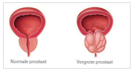 prostaatklachten